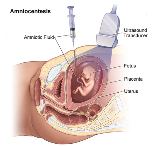 amniocentesis